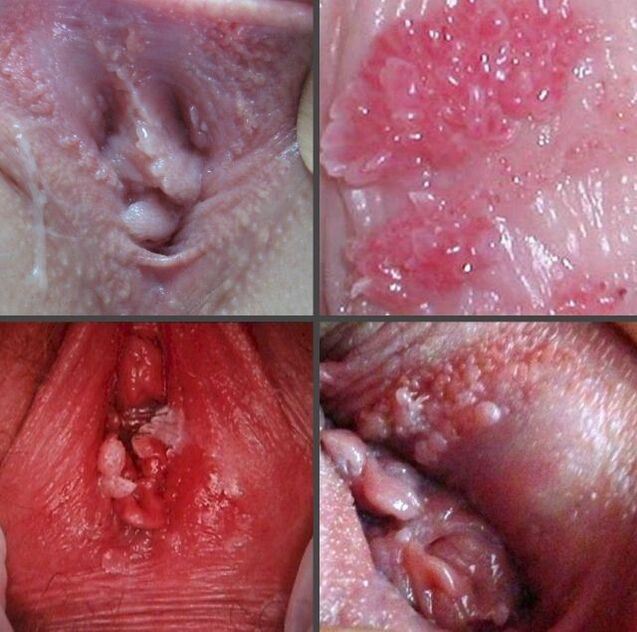 Nahaufnahme von Papillomen in der Vagina