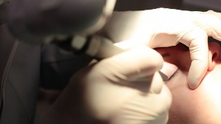 Laserentfernung von Papillomen am Augenlid. 